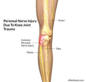 image of the peroneal nerve