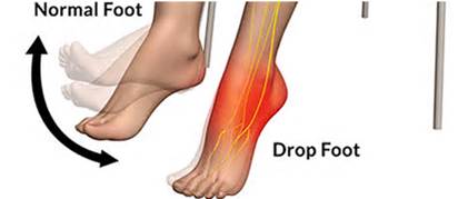 Drop Foot