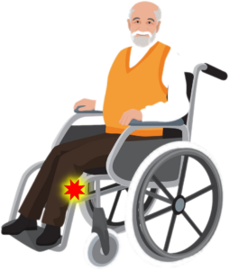 man in a wheelchair with compression on the peroneal nerve