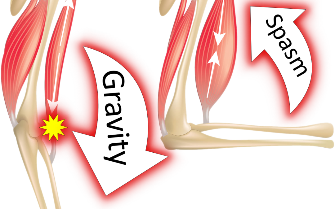 What is spasticity?