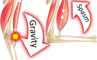 What is spasticity?