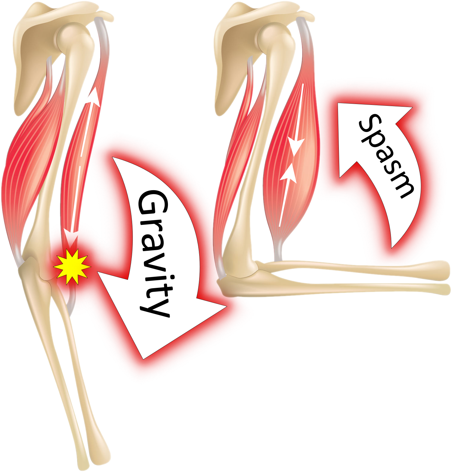 vector image of bicep spasticity