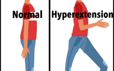 Knee Hyperextension after a Stroke: Causes and Treatment
