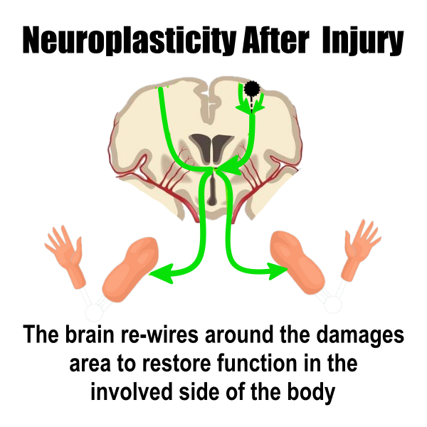 vector image of how the brain rewires after a stroke
