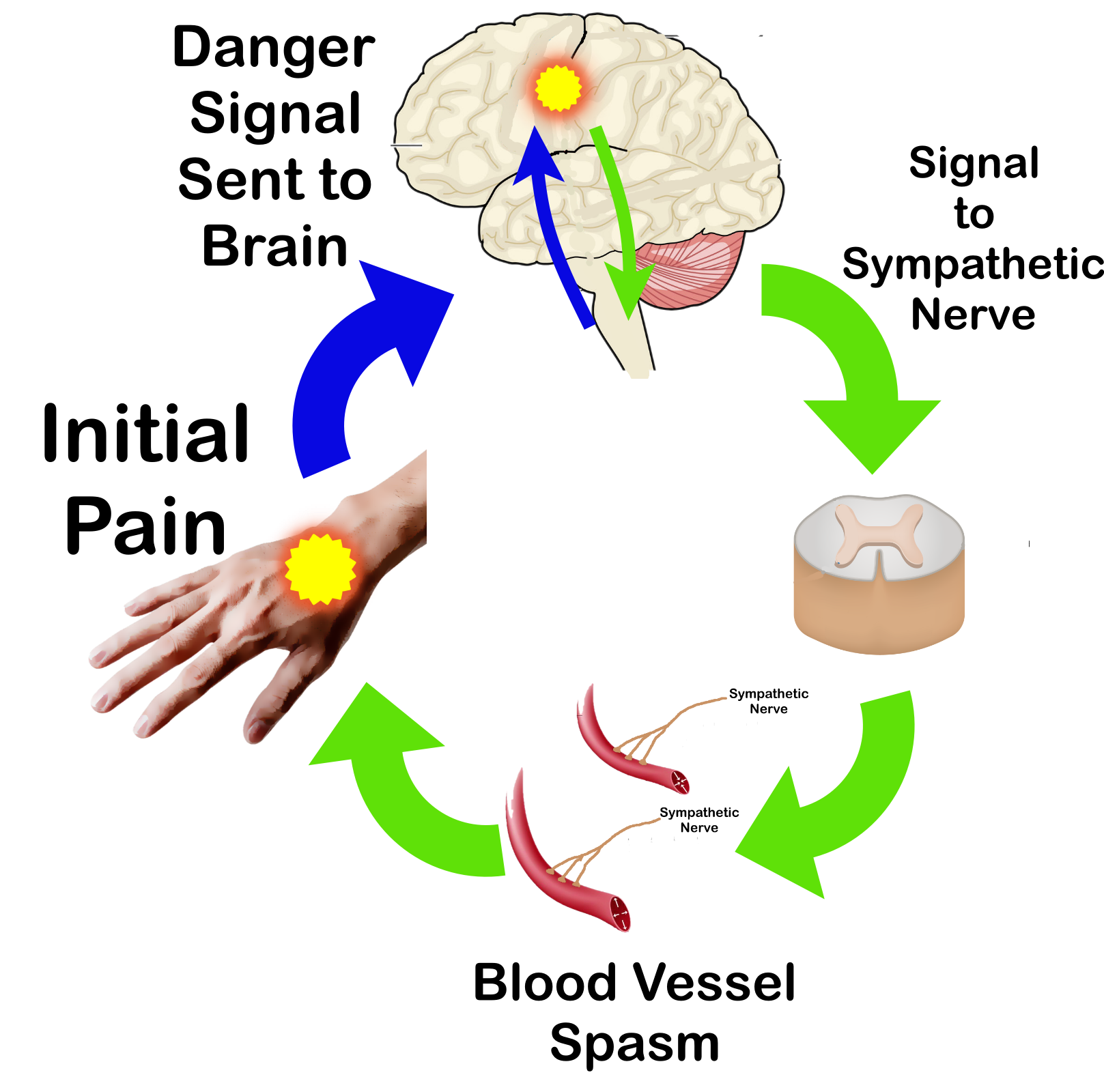 complex regional pain syndrome