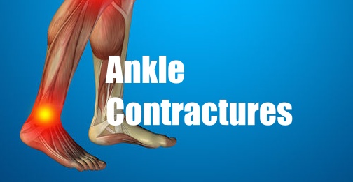 Ankle Contractures: Best and worst treatments